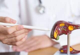 Les différents stades du cancer du foie