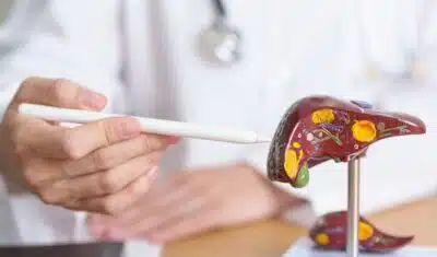 Les différents stades du cancer du foie